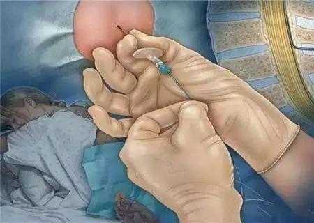 剖腹产的胎儿(剖腹产阴道口会扩张吗) 第3张 剖腹产的胎儿(剖腹产阴道口会扩张吗) 第3张