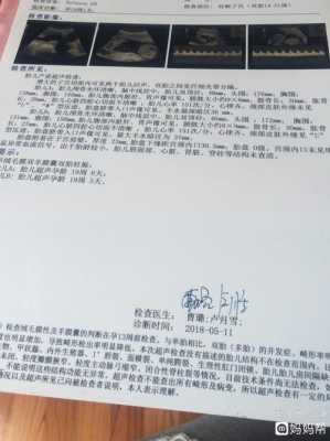 胎儿颈后见u型压迹是什么意思,胎儿u型压迹是什么意思 第2张 胎儿颈后见u型压迹是什么意思,胎儿u型压迹是什么意思 第2张
