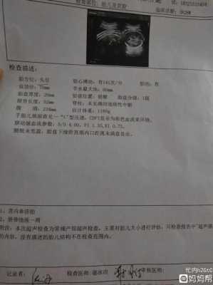 胎儿颈后见u型压迹是什么意思,胎儿u型压迹是什么意思 第1张 胎儿颈后见u型压迹是什么意思,胎儿u型压迹是什么意思 第1张