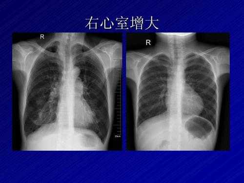 胎儿右心室强光斑(胎儿右心室强光斑是什么意思,严重吗) 第2张 胎儿右心室强光斑(胎儿右心室强光斑是什么意思,严重吗) 第2张