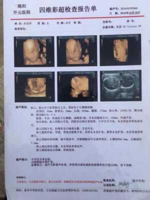 b超能看出胎儿畸形吗(婴儿消化道畸形B超可以检查出来吗) 第2张 b超能看出胎儿畸形吗(婴儿消化道畸形B超可以检查出来吗) 第2张