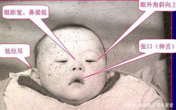 怀唐氏儿的孕妈妈有什么症状呀,唐氏儿孕妇孕期症状 第1张 怀唐氏儿的孕妈妈有什么症状呀,唐氏儿孕妇孕期症状 第1张
