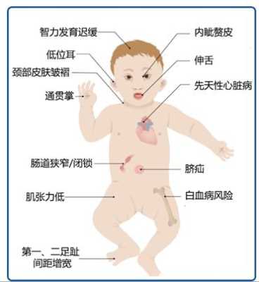 怀唐氏儿的孕妈妈有什么症状呀,唐氏儿孕妇孕期症状 第2张 怀唐氏儿的孕妈妈有什么症状呀,唐氏儿孕妇孕期症状 第2张