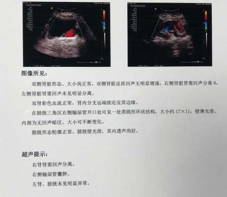 输尿管囊肿怎么办,胎儿输尿管囊肿2周消失了 第2张 输尿管囊肿怎么办,胎儿输尿管囊肿2周消失了 第2张