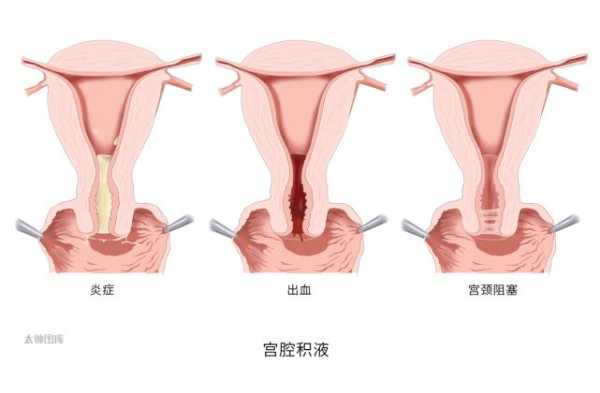 积液对胎儿有影响吗(怀孕宫颈积液对胎儿有影响吗) 第1张 积液对胎儿有影响吗(怀孕宫颈积液对胎儿有影响吗) 第1张