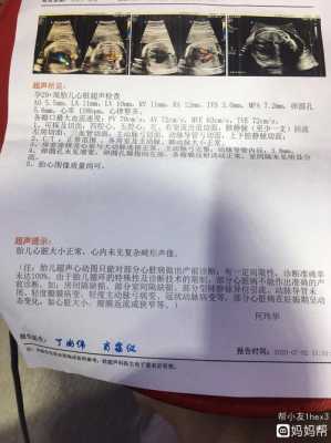 一个胎儿超声心动图检查,必须要做吗,胎儿超声图片 第1张 一个胎儿超声心动图检查,必须要做吗,胎儿超声图片 第1张