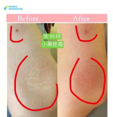 妊娠纹是什么意思,怀孕期间妊娠纹怎么可以彻底消除 第1张 妊娠纹是什么意思,怀孕期间妊娠纹怎么可以彻底消除 第1张