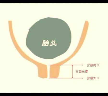 孕5个月宫颈长度短怎么办,孕期宫颈短怎么长上去 第2张 孕5个月宫颈长度短怎么办,孕期宫颈短怎么长上去 第2张