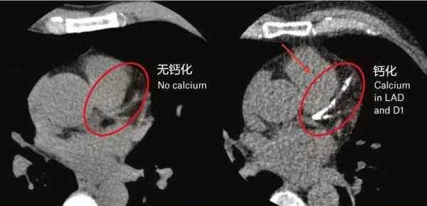 胎儿钙化是什么意思(胎儿钙化是什么意思?) 第1张 胎儿钙化是什么意思(胎儿钙化是什么意思?) 第1张