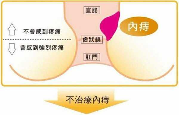 孕妇得痔疮了怎么办,内痔和外痔的区别图片 第3张 孕妇得痔疮了怎么办,内痔和外痔的区别图片 第3张