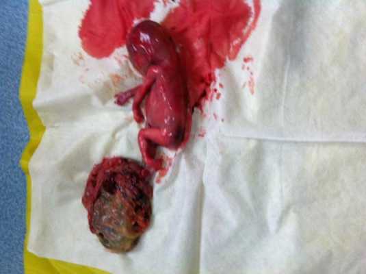 胎儿腹腔囊性包块(子宫囊性包块怎么办) 第2张 胎儿腹腔囊性包块(子宫囊性包块怎么办) 第2张