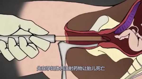 流产的胎儿怎么处理(流产的胎儿怎么处理) 第2张 流产的胎儿怎么处理(流产的胎儿怎么处理) 第2张