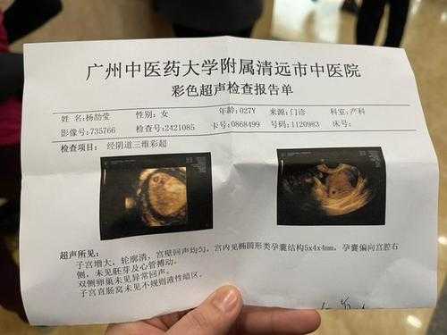 孕期彩超需要空腹吗(彩超不能吃东西吗) 第2张 孕期彩超需要空腹吗(彩超不能吃东西吗) 第2张