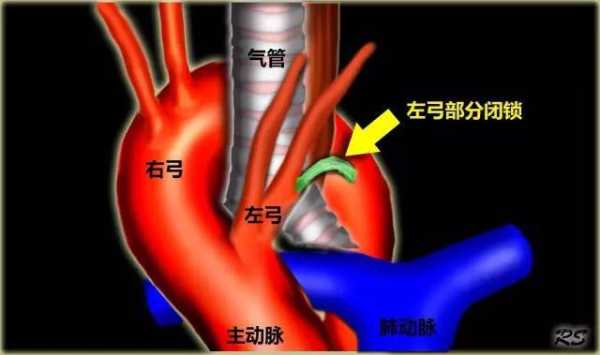主动脉弓是什么意思,胎儿双主动脉弓能生吗? 第1张 主动脉弓是什么意思,胎儿双主动脉弓能生吗? 第1张