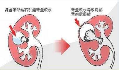 孕晚期胎儿肾积水(孕晚期胎儿肾积水是什么原因引起的) 第2张 孕晚期胎儿肾积水(孕晚期胎儿肾积水是什么原因引起的) 第2张