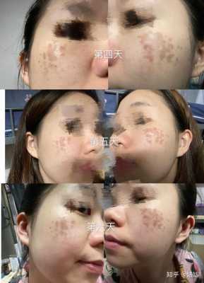 孕妇可以激光祛斑吗,激光对胎儿有影响吗? 第1张 孕妇可以激光祛斑吗,激光对胎儿有影响吗? 第1张