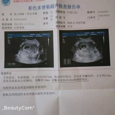 胎儿性暗区(胎儿腹部暗区) 第2张 胎儿性暗区(胎儿腹部暗区) 第2张