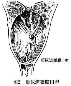 胎儿后尿道瓣膜(胎儿后尿道瓣膜) 第2张 胎儿后尿道瓣膜(胎儿后尿道瓣膜) 第2张
