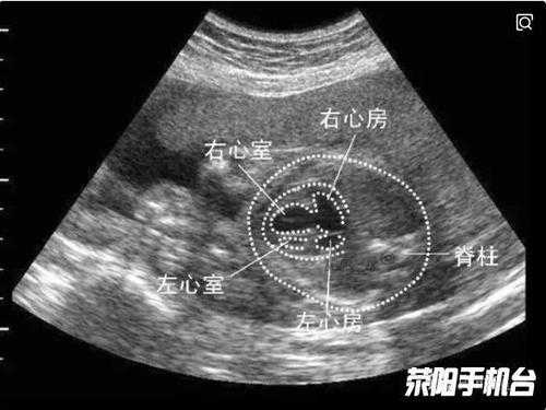 胎儿心脏畸(胎儿右心位会导致心脏畸形吗) 第2张 胎儿心脏畸(胎儿右心位会导致心脏畸形吗) 第2张