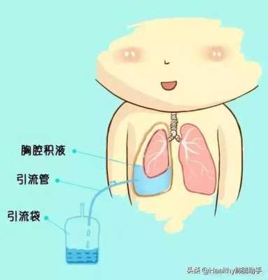 胎儿心包积液怎么办(胸腔积液心包积液怎么治疗) 第1张 胎儿心包积液怎么办(胸腔积液心包积液怎么治疗) 第1张