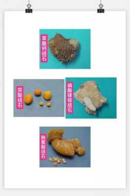 有身孕得肾结石怎么办,肾结石孕期还能补钙吗 第1张 有身孕得肾结石怎么办,肾结石孕期还能补钙吗 第1张