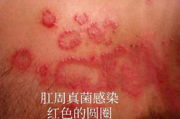 胎儿肛门(两岁的宝宝大便是有红色的肉在屁眼哪里) 第2张 胎儿肛门(两岁的宝宝大便是有红色的肉在屁眼哪里) 第2张
