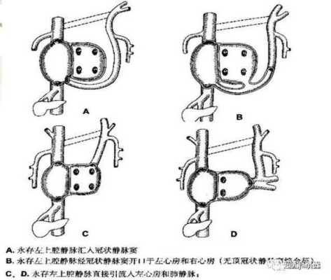 胎儿左上腔静脉永存(胎儿左上腔静脉永存) 第2张 胎儿左上腔静脉永存(胎儿左上腔静脉永存) 第2张