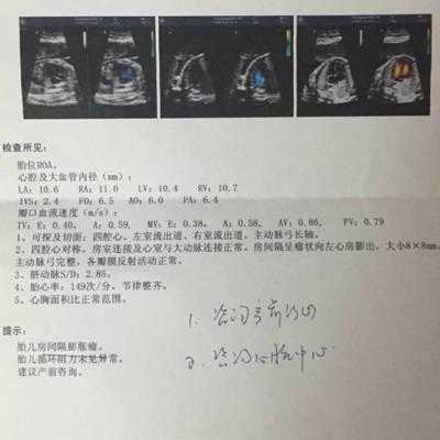 胎儿房间隔膨出瘤(胎儿房间隔膨出瘤出生后有什么影响) 第2张 胎儿房间隔膨出瘤(胎儿房间隔膨出瘤出生后有什么影响) 第2张