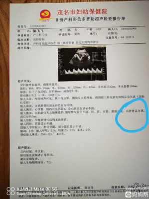 胎儿右肾双肾盂(27周的胎儿产检发现只有一个肾可以生吗) 第2张 胎儿右肾双肾盂(27周的胎儿产检发现只有一个肾可以生吗) 第2张