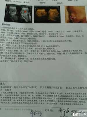 胎儿双肾肾窦分离是否严重,胎儿肾窦分离是什么意思 第2张 胎儿双肾肾窦分离是否严重,胎儿肾窦分离是什么意思 第2张