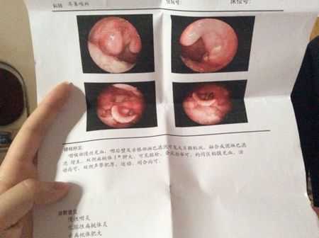孕妇嗓子发炎肿痛怎么办,孕期喉咙肿痛怎么办咽口水都痛怎么办 第2张 孕妇嗓子发炎肿痛怎么办,孕期喉咙肿痛怎么办咽口水都痛怎么办 第2张