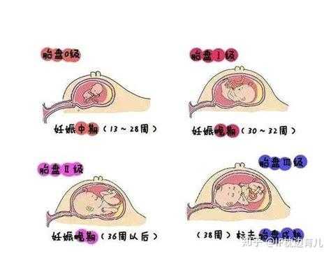 孕妇羊水多怎么办,胎儿羊水过多怎么办,34周60mm 第2张 孕妇羊水多怎么办,胎儿羊水过多怎么办,34周60mm 第2张