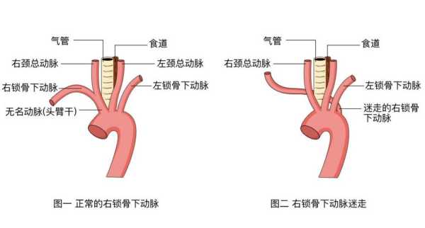 胎儿迷(胎儿迷走右锁骨下动脉什么意思) 第2张 胎儿迷(胎儿迷走右锁骨下动脉什么意思) 第2张