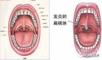 孕期喉咙痛怎么回事,怀孕期间喉咙痛怎么办咽口水都痛 第3张 孕期喉咙痛怎么回事,怀孕期间喉咙痛怎么办咽口水都痛 第3张