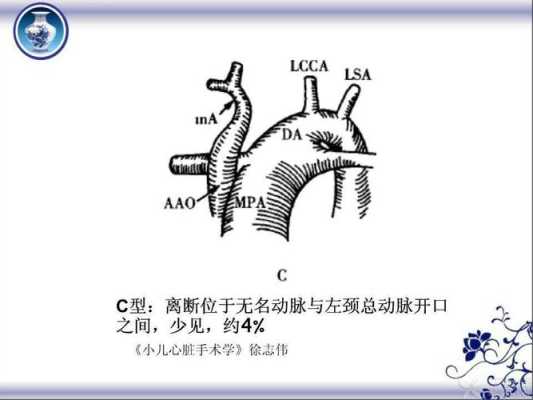 胎儿主动脉弓离断(胎儿主动脉弓离断) 第2张 胎儿主动脉弓离断(胎儿主动脉弓离断) 第2张