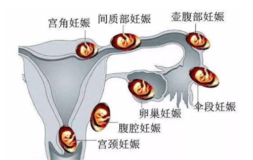 胎儿是生活在（  ） ，A．输卵管，B．子宫，C．卵巢，D．阴,胎儿卵巢囊肿是什么原因引起的 第1张