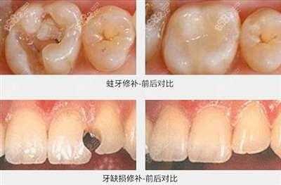 备孕期间可以补牙吗,备孕期间能补牙吗有影响吗 第2张 备孕期间可以补牙吗,备孕期间能补牙吗有影响吗 第2张