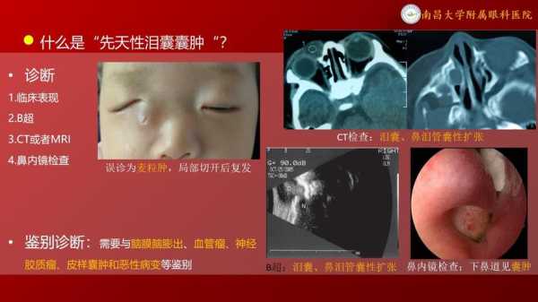 胎儿泪囊囊肿（胎儿泪囊囊肿会自己消失吗）  第1张