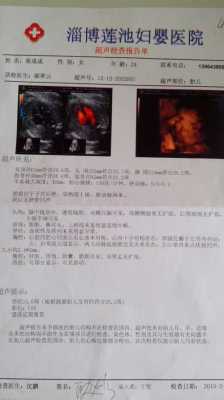 单肾胎儿(四维彩超双肾分离怎么回事) 第2张 单肾胎儿(四维彩超双肾分离怎么回事) 第2张