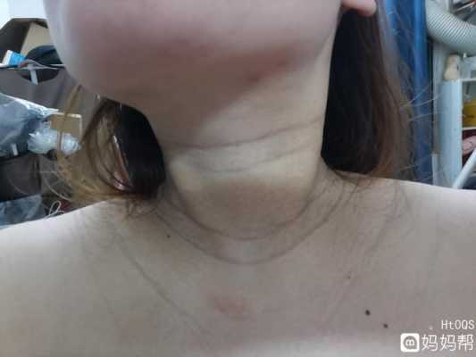 孕期脖子黑怎么回事（孕妇脖子和腋下变黑是怎么回事）  第2张