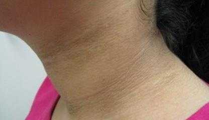 孕期脖子黑怎么回事（孕妇脖子和腋下变黑是怎么回事）  第1张
