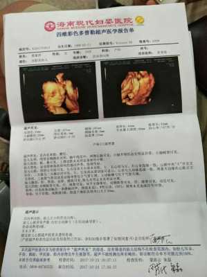 胎儿系统超声检查是检查什么的,胎儿心脏超声筛查是四维吗 第2张 胎儿系统超声检查是检查什么的,胎儿心脏超声筛查是四维吗 第2张