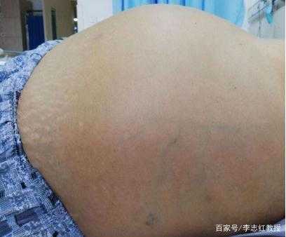小孩腹腔积液是怎么回事,胎儿腹腔少量积液是什么意思 第2张 小孩腹腔积液是怎么回事,胎儿腹腔少量积液是什么意思 第2张