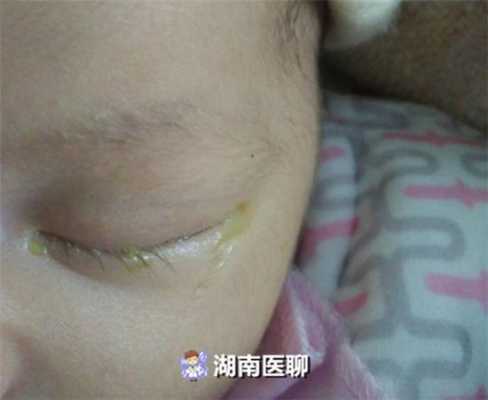 5个月宝宝眼睛眼屎多,怀孕五个月胎儿有多重 第1张 5个月宝宝眼睛眼屎多,怀孕五个月胎儿有多重 第1张
