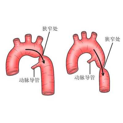 主动脉缩窄怎么办,胎儿主动脉弓狭窄,能不能要?  第2张