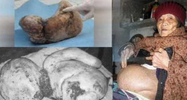 胎儿死在腹中的原因有哪些,胎儿死在腹中是什么症状 第1张 胎儿死在腹中的原因有哪些,胎儿死在腹中是什么症状 第1张