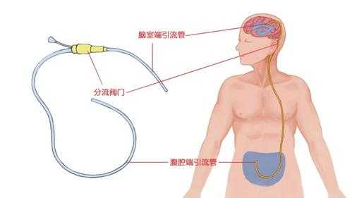 备孕期可以做指甲吗(脑级水手术后能要孩子吗) 第2张 备孕期可以做指甲吗(脑级水手术后能要孩子吗) 第2张