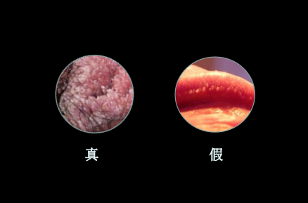 怀孕四个月发现有湿疣湿疣病怎么根治,孕期尖锐疣体需要治疗吗 第1张 怀孕四个月发现有湿疣湿疣病怎么根治,孕期尖锐疣体需要治疗吗 第1张