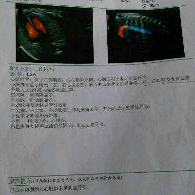 胎儿心脏四维彩超能检查出什么,胎儿心脏彩超检查什么内容  第1张