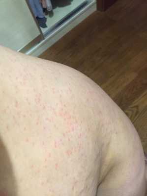 孕妇长湿疹怎么办,孕期湿疹怎么办啊图片 第1张 孕妇长湿疹怎么办,孕期湿疹怎么办啊图片 第1张